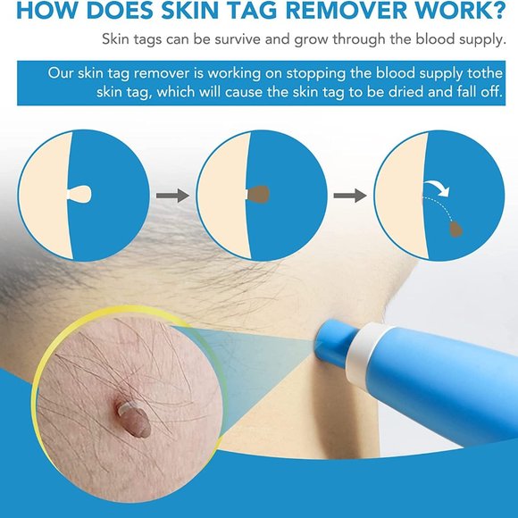 Auto Micro Skin Tag Remover Device Kit - Picture 4 of 8